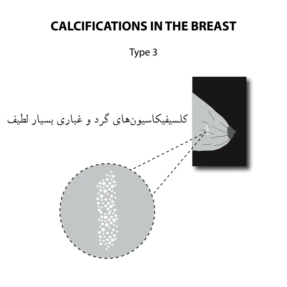 کلسیفیکاسیون پستان