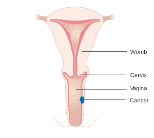 درمان سرطان واژن