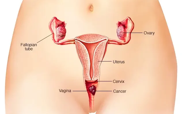 سرطان واژن