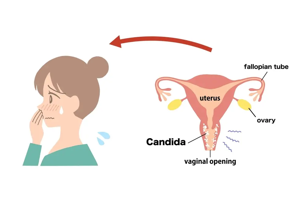 ترشحات واژن و سرطان