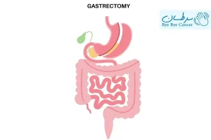 گاسترکتومی