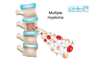 مولتیپل میلوما