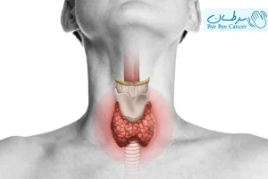 کم کاری تیروئید بخاطر پرتودرمانی سر و گردن