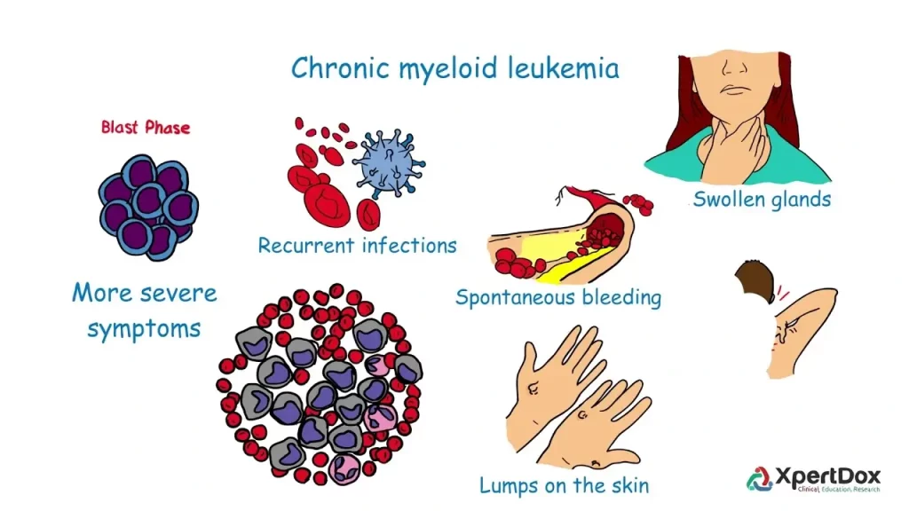 تشخیص سرطان CML