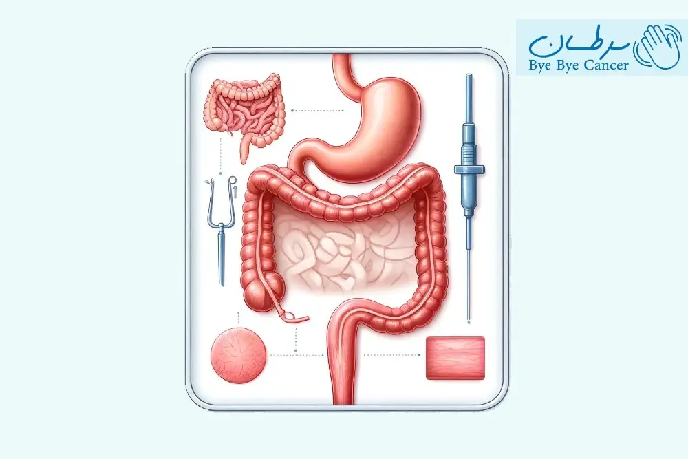 بای پس معده و سرطان