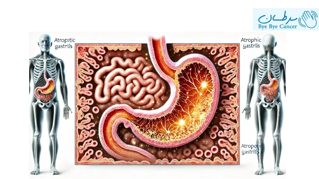 گاستریت اتروفیک