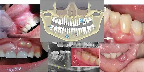 کیست دندان باعث سرطان می شود