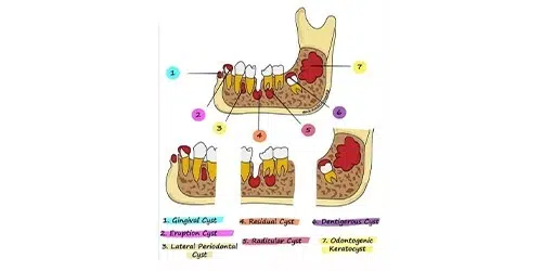 انواع کیست دندان