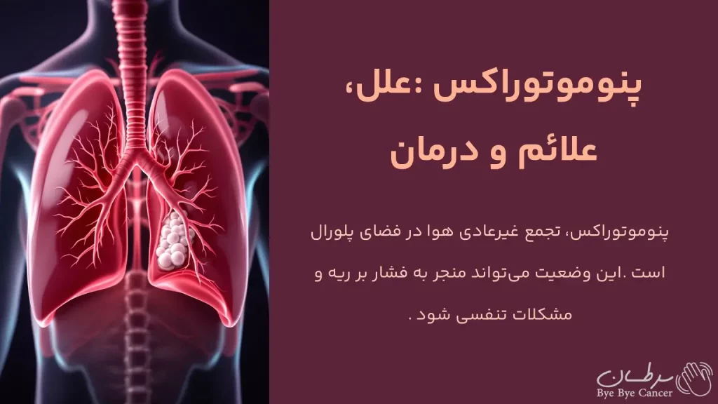 پنوموتوراکس