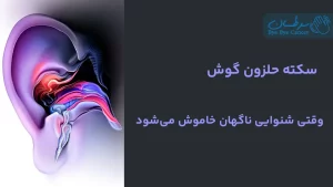 سکته حلزون گوش