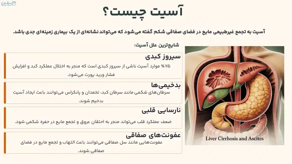 آسیت چیست؟
