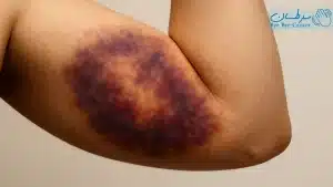 هماتوم